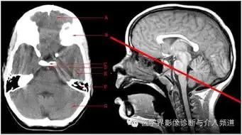 带备注的大脑ct图谱,这8张真的不一样哦