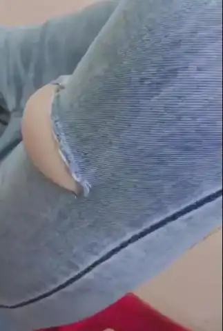 溜冰摔的膝盖鼓起一个大包肿成这样真的是很罕见啊,哈哈哈哈哈哈