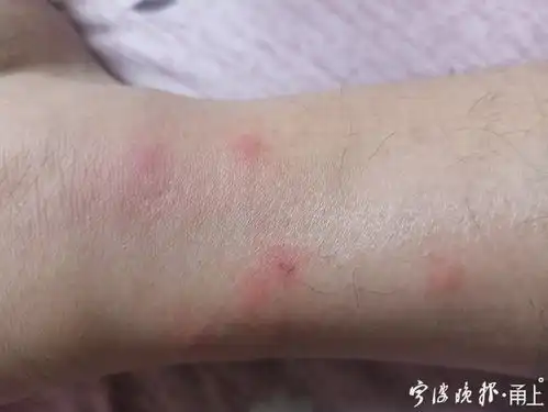 一只手掌布满被拍死的蚊子这张照片背后的故事又心酸又好笑