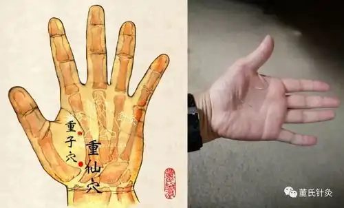 董氏针灸林正泰微课堂案例分享重子重仙穴