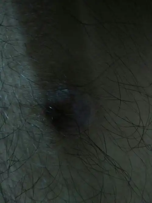 膝盖上受了伤,蹭掉了一块皮,伤好后,不知是因为伤口没处理好还是怎么回事,伤口处鼓起一个包来,这是怎