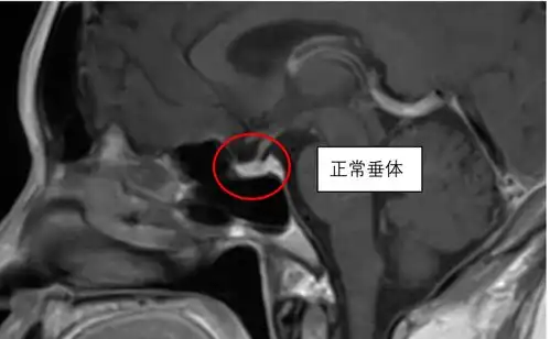 47岁女士以为当奶奶累得更年期提前,一查竟是脑子里长了个雪人