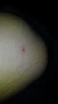 膝盖上长了几个小疙瘩