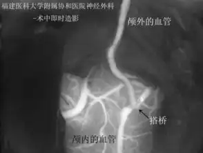 福建女子中风反复发作,医生为她大脑内搭桥,得了这种病不用再往省外跑了