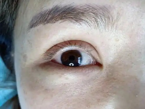 双眼皮做成大小眼小姐姐最终选择去修复,术后恢复简直太美了