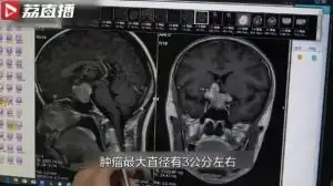 21岁女生每月3次月经病因在大脑21岁女生每月3次大姨妈,竟是脑肿瘤捣乱