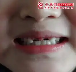 梦见上门牙掉了