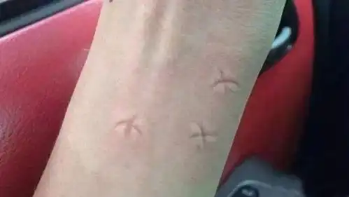 在被蚊子咬后,在蚊包上打十字架有什么用呢只是为了好玩吗