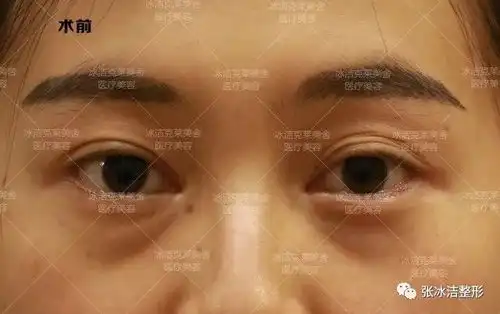 埋线修复内眼角修复双眼皮变三眼皮,疤痕太明显,埋线还能做成这样