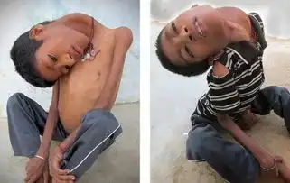 印度男孩患罕见疾病脖子弯曲头部倒垂